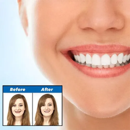 Виниры для зубов Perfect smile veneers. Голливудская улыбка - фото 5