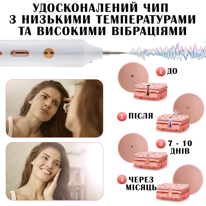 Портативный косметический плазменный коагулятор Mole Point – удаление папиллом, бородавок, пигментных пятен фото - 6
